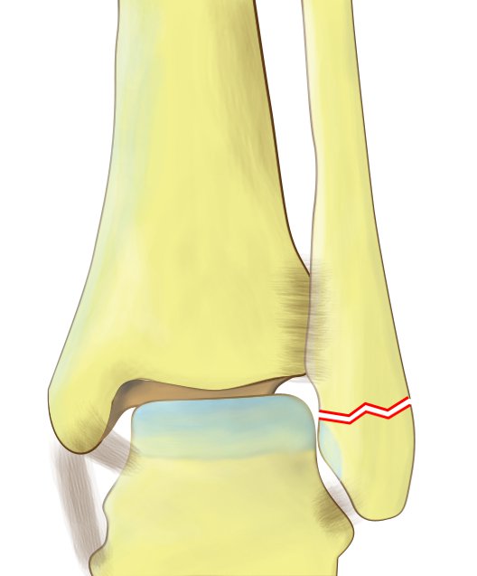 Weber A fracture of distal fibula