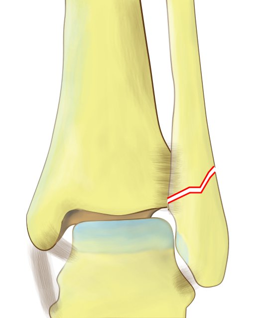 Weber B fracture of distal fibula