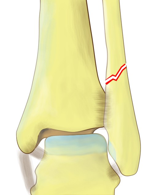 Weber C fracture of distal fibula