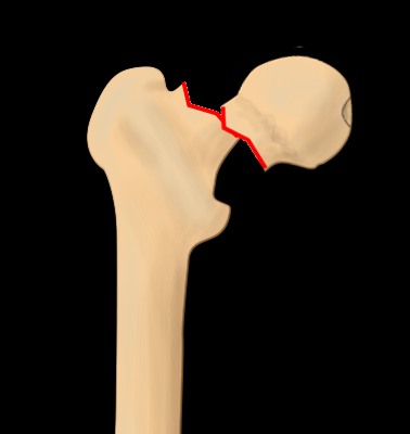 Garden classification of hip fractures - femoral neck, stage IV
