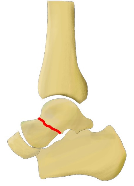 Hawkin's classification of talar neck fractures - type I