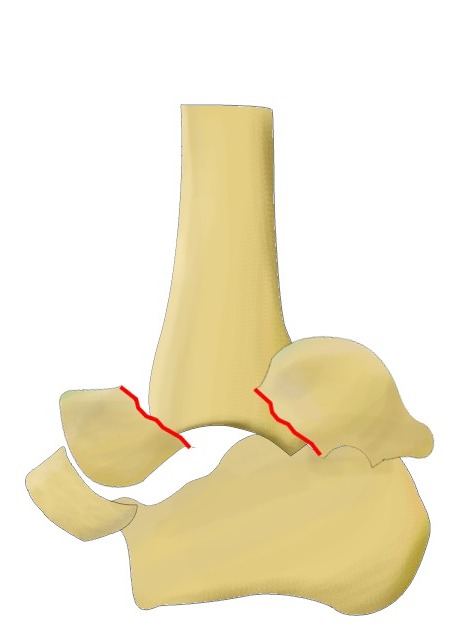 Hawkin's classification of talar neck fractures - type IV