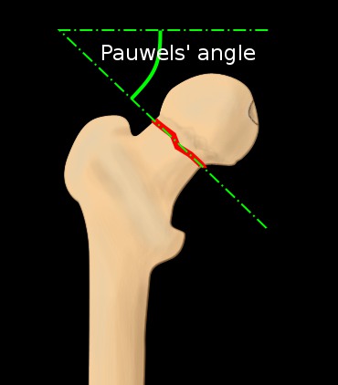 Pauwels classification of hip fractures - Pauwels angle, femoral neck