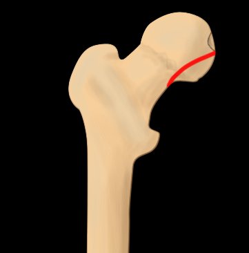 Pipkin classification of fractures of femoral head - type I