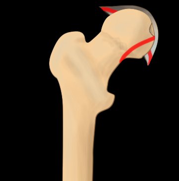 Pipkin classification of fractures of femoral head - type IV
