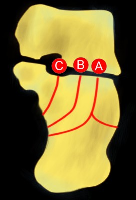 Inferior Calcaneal Spur