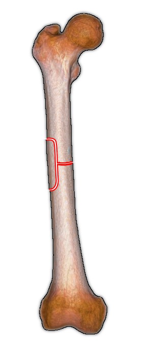 Winquist and Hansen classification of femoral shaft fractures - thigh bone - Winquist Grade II