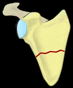 Zdravkovic classification of scapular fractures, shoulder blade, trauma, zdravkovic I