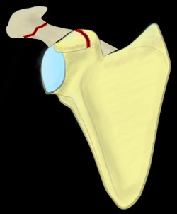 Zdravkovic classification of scapular fractures, shoulder blade, trauma, zdravkovic II